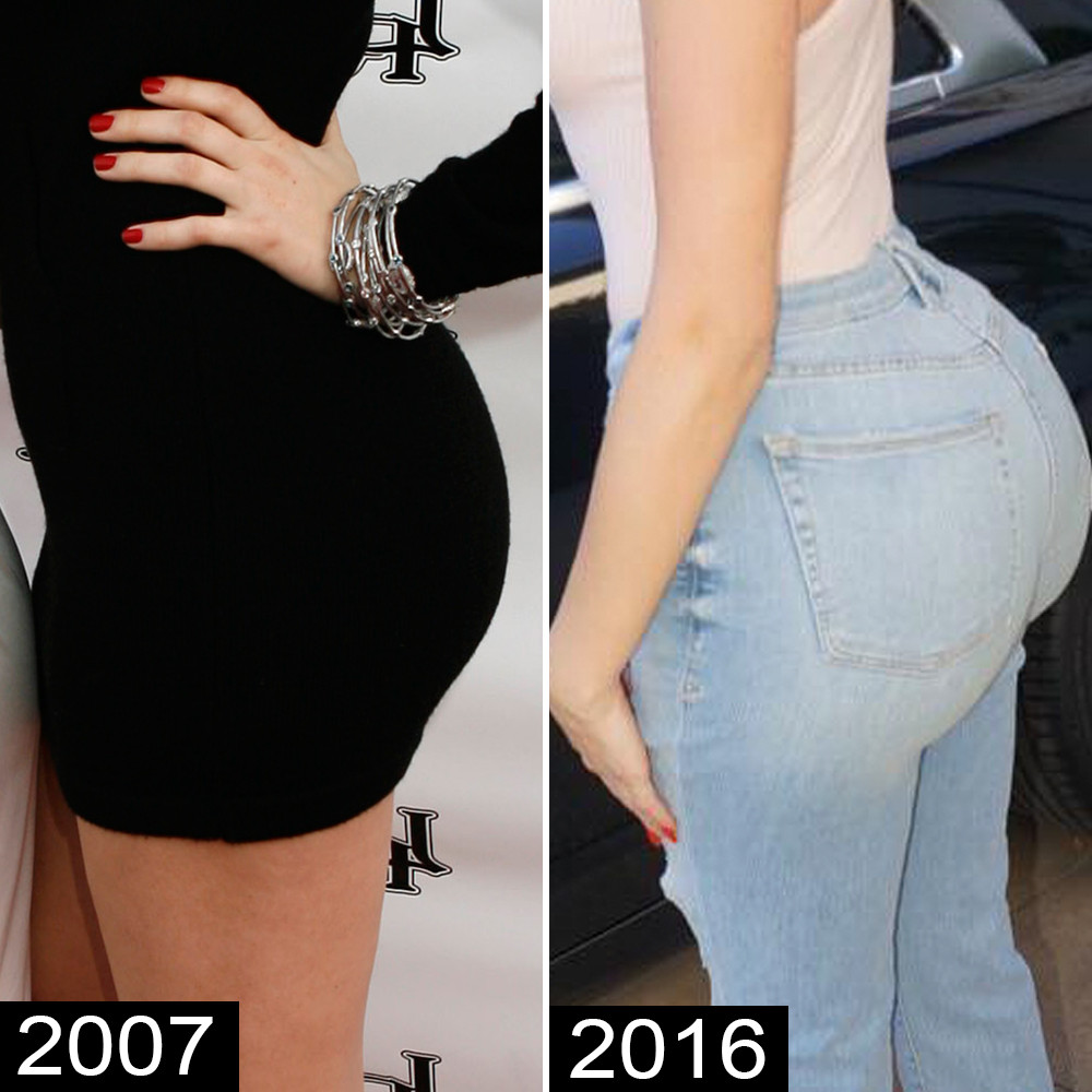 KhloÃ© Kardashian Before and After: See Her Complete ...