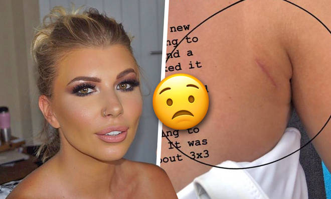 Love Island's Olivia Buckland Reveals Scar After Worrying ...