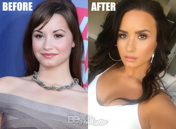 Demi Lovato Plastic Surgery Before and After Photos, Secrets