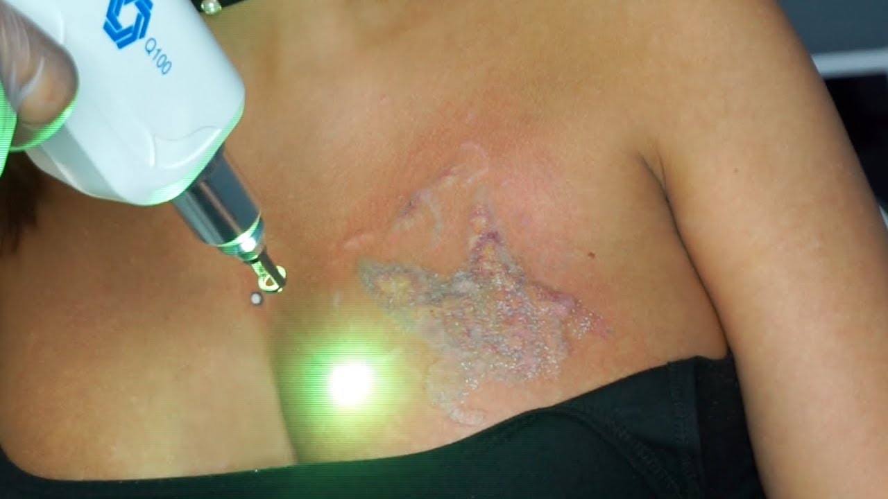 Laser Tattoo Removal Experience Session 3 Update with Qu0026A - YouTube
